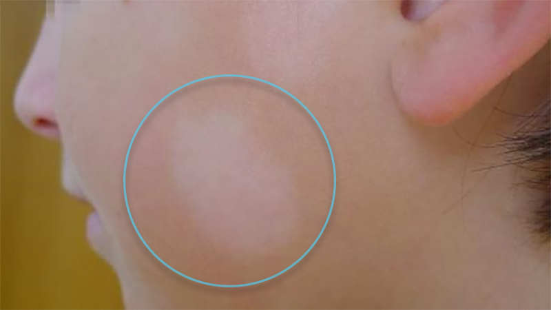 Detalle de manchas blancas en la cara en un menor